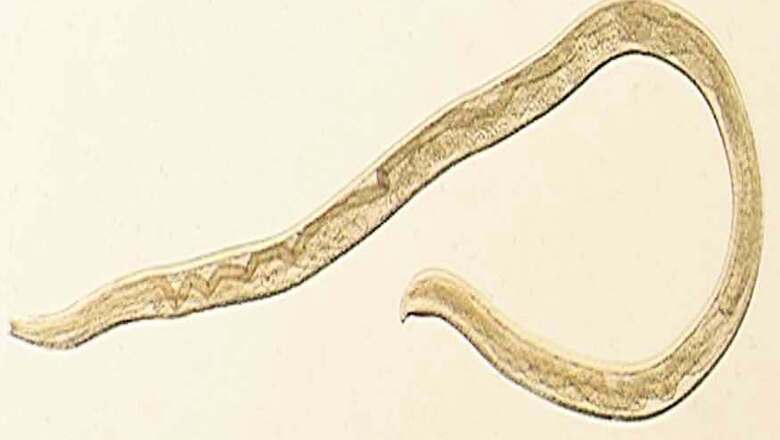 US Woman Found With Eye Worm Previously Known Only in Cattle