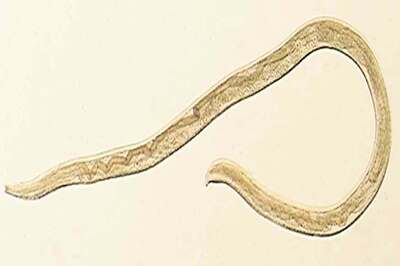 US Woman Found With Eye Worm Previously Known Only in Cattle