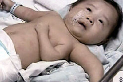 China's three-armed wonder baby