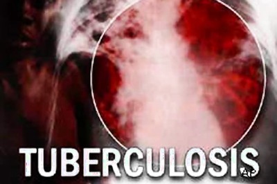 India recorded largest number of TB cases in 2014