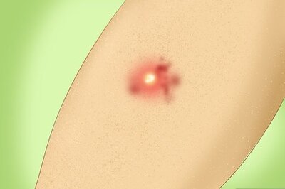 How to Treat a Staph Infection
