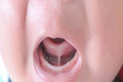 What is Tongue-tie Among Children? Symptoms And Other Things You Need to Know