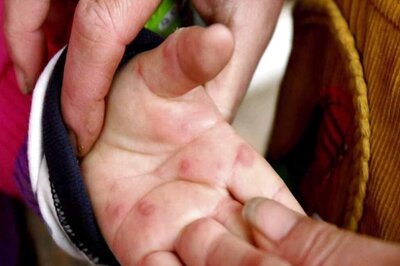 Dengue After-Effect or Link to Monkeypox & Covid? As Tomato Flu Spreads, News18 Decodes Disease