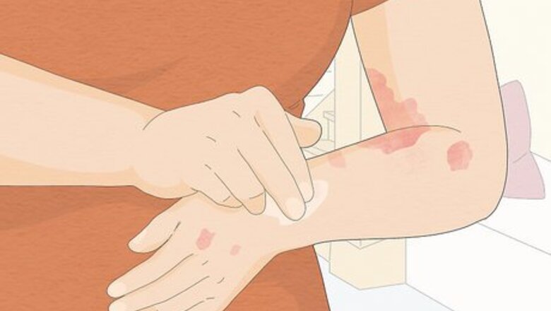 How to Use Aloe Vera to Treat Eczema