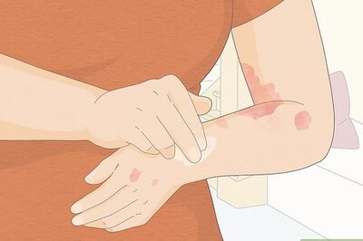 How to Use Aloe Vera to Treat Eczema