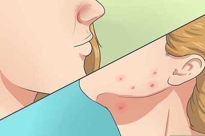How to Heal Acne Fast and Naturally