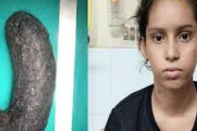 After 5-hour Surgery, 16cm Hairball Removed From 17-year-old Girl's Stomach