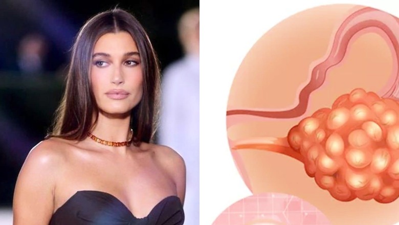 Hailey Bieber Has an “Apple Size” Ovarian Cyst; Know What Are the Causes and Symptoms