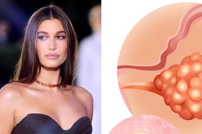 Hailey Bieber Has an “Apple Size” Ovarian Cyst; Know What Are the Causes and Symptoms