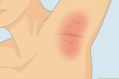 How to Treat a Yeast Infection on Your Skin