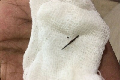 Sewing Needle Removed from Kerala Man's Body After 22 Years