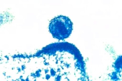 Study Identifies Virulent HIV Variant Unrecognized For Years