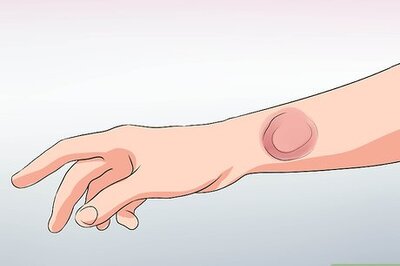How to Recognize Lyme Disease Symptoms