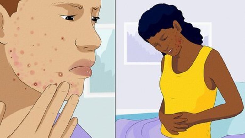 How to Treat Hormonal Acne: Ask a Dermatologist
