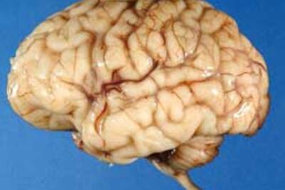 Root of autism lies in genes