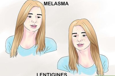 How to Treat Hyperpigmentation