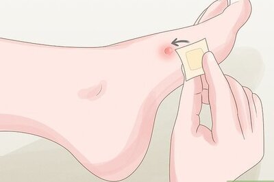 Proven Ways to Treat and Manage Climbing Blisters