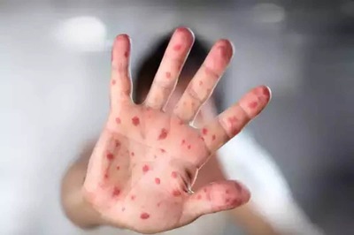 Clade 9 Chickenpox Variant in India: Symptoms, Prevention, and Details