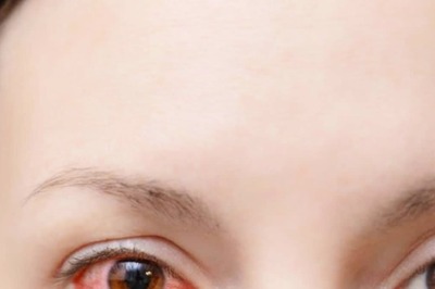 Conjunctivitis Memes Take Over Twitter as Eye Infection Cases Rise in Delhi-NCR