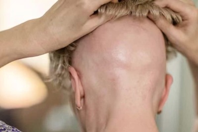 How This UK Woman Overcame Rare Autoimmune Disease That Resulted In Severe Hair Loss