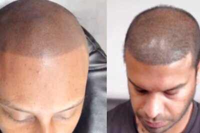 Watch: Bald Man Gets Hair Tattooed On His Head