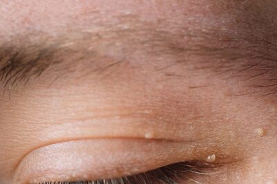 Cure and Causes of Milia, the Little White Bumps on Ones Face