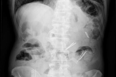 Doctors Find Shaving Blades, Needles, Chain, 263 Coins Inside Man's stomach in MP