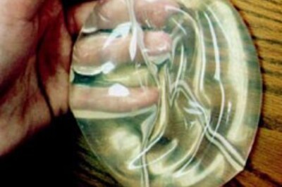 Breast implants saves Israeli woman