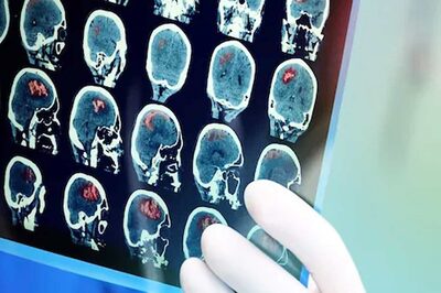 What Are The Main Causes of Brain Stroke? Look For These Symptoms