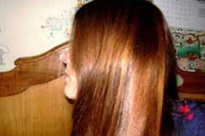 Hair loss culprit found: It's a gene!