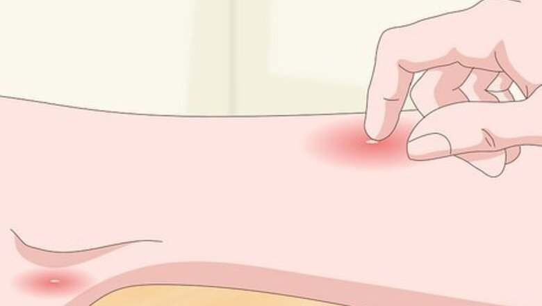 How to Detect Flea Bites