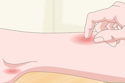 How to Detect Flea Bites