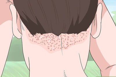 How to Heal Scalp Eczema