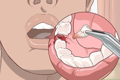 How to Prepare for Tooth Extraction