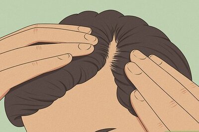 5 Signs of a Receding Hairline & How to Reverse It