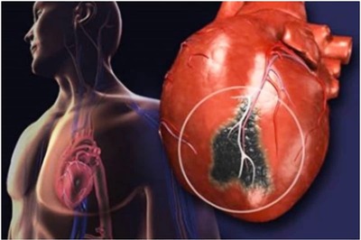 Know Everything About Preventive Cardiology, an Emerging Field to Prevent Heart Diseases