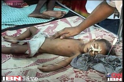 UP: Encephalitis kills 30 children in 5 days in Gorakhpur