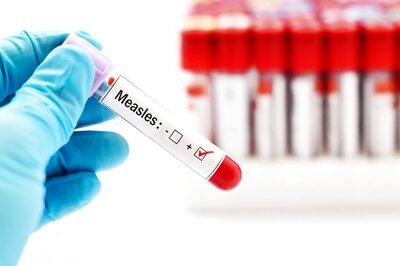 Measles Mayhem: 84 Cases in 2 Months, 3 Deaths in 48 Hrs Put Mumbai on Alert | Know Symptoms, Cure
