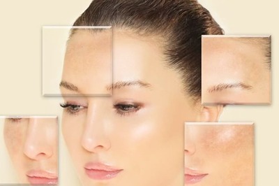 Hyperpigmentation: What To Do To Prevent It?