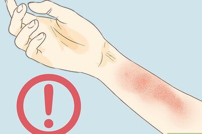 How to Treat Poison Ivy and Poison Oak