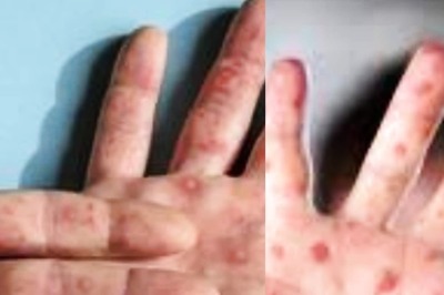 Monkeypox VS Tomato Flu: Know The Key Differences Between Symptoms