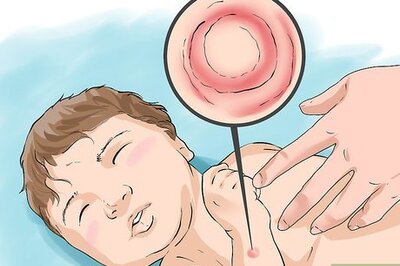 How to Treat Ringworm in Babies