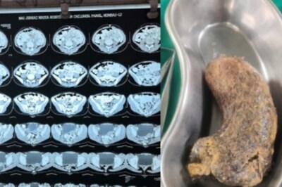 Mumbai Docs Extract 100 gm 'hairball' From Minor Girl's Tummy