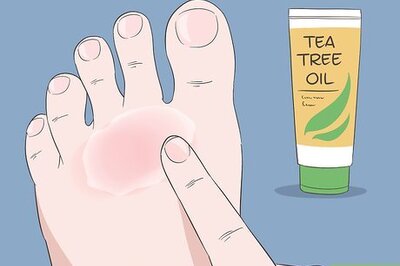 How to Cure Athlete's Foot: Can Natural Remedies Help?