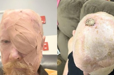 Australian Man's Struggle With Melanoma Exposes Lack Of Sun Safety Measures