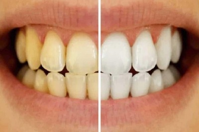 Ways to Care for Your Teeth After a Whitening Treatment