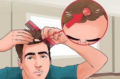 How to Treat Scalp Ringworm