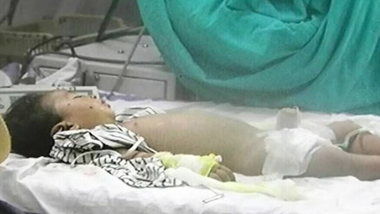 Hospital Blames Technician as Kids Die Due to Anaesthesia-Oxygen Mixup