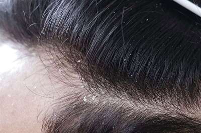 The Mane Dilemma: Understanding Hair Loss and Effective Solutions