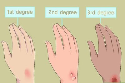 How to Treat a Serious Burn